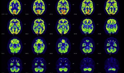 Scansione cerebrale con tomografia a emissione di positroni con fluorodesossiglucosio.
