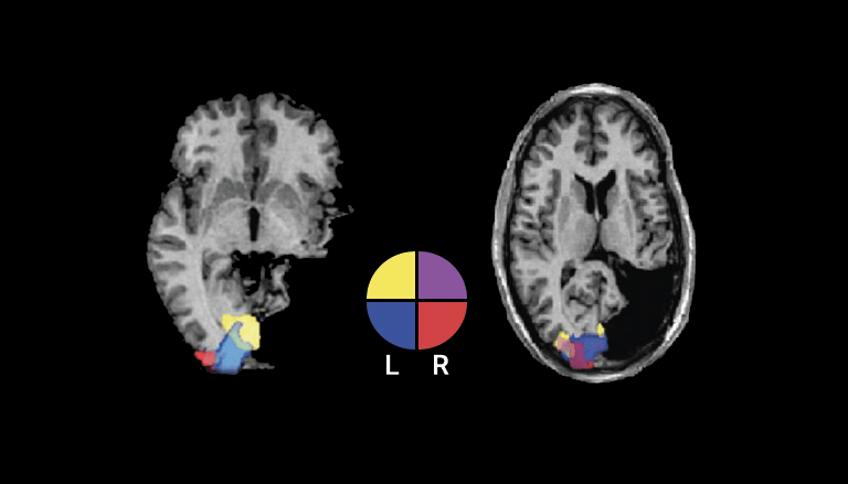 Immagine di risonanza magnetica funzionale tratta dalla letteratura sulla plasticità cerebrale
